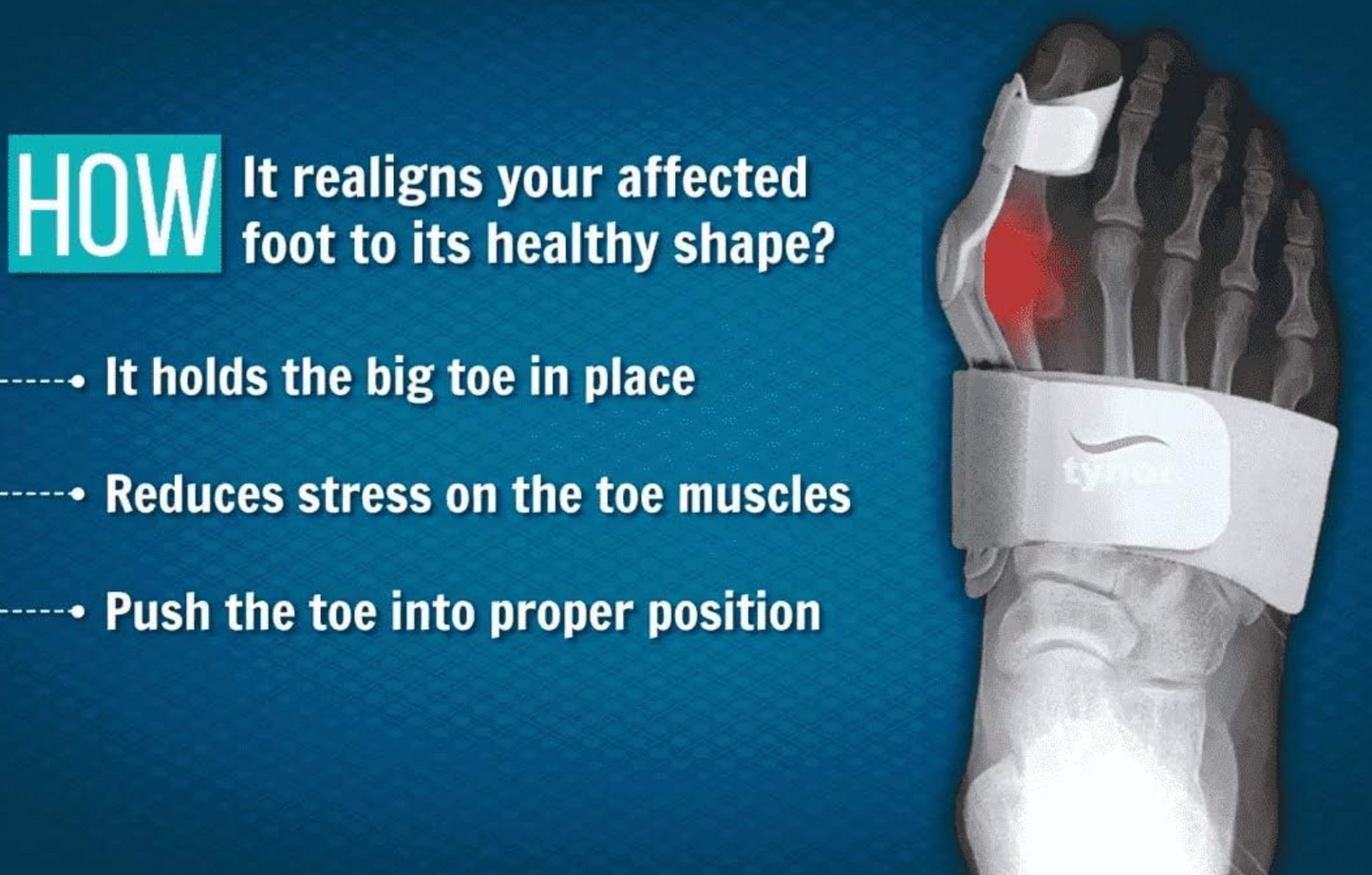 Silicone Bunion Corrector | Orthopedic Toe Separator Splint for Pain Relief